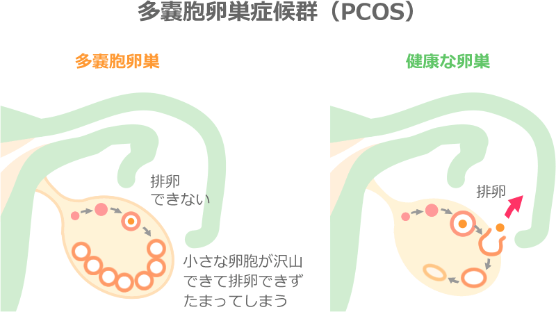 多嚢胞卵巣症候群（PCOS）−多嚢胞卵巣と健康な卵巣
